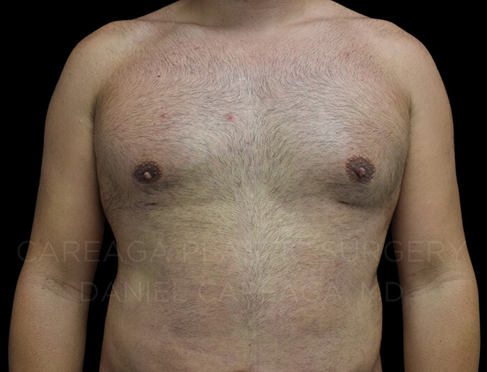 Gynecomastia after