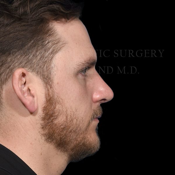 Rhinoplasty after